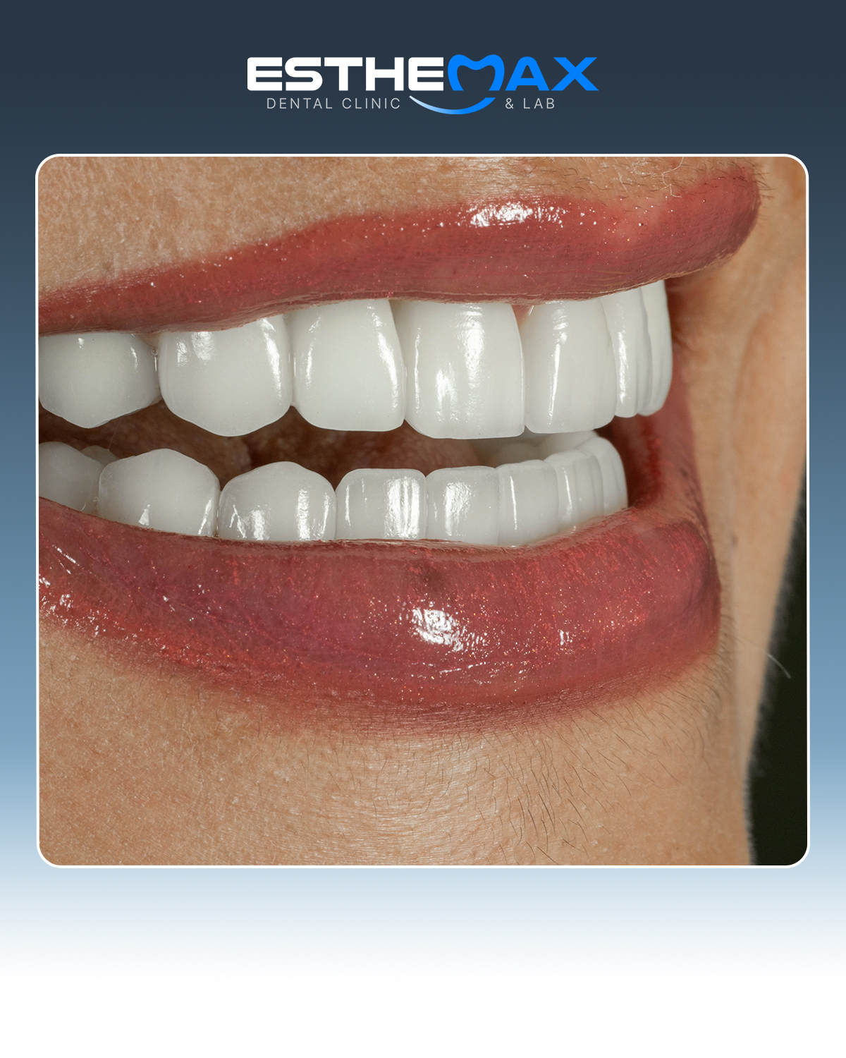 Beautiful smile result by ESTHEMAX Dental Clinic