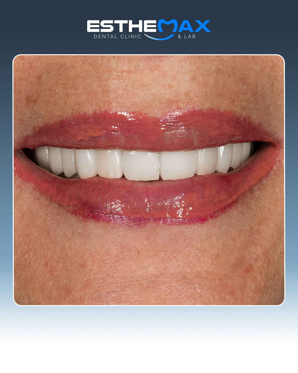 Dental work - veneers