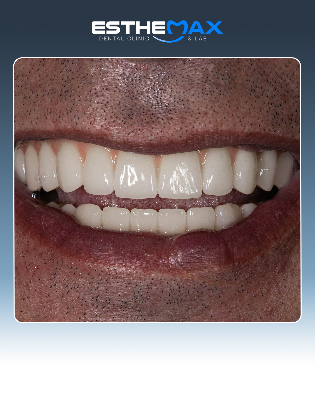 Dental work - natural teeth