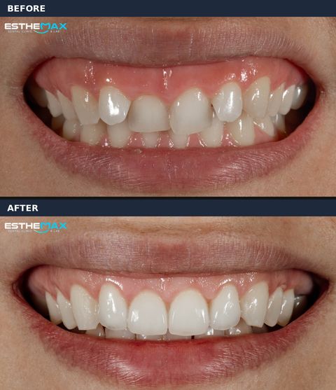 Before and after veneers: a darkened front tooth and uneven edges replaced by an even, natural smile (view full size)