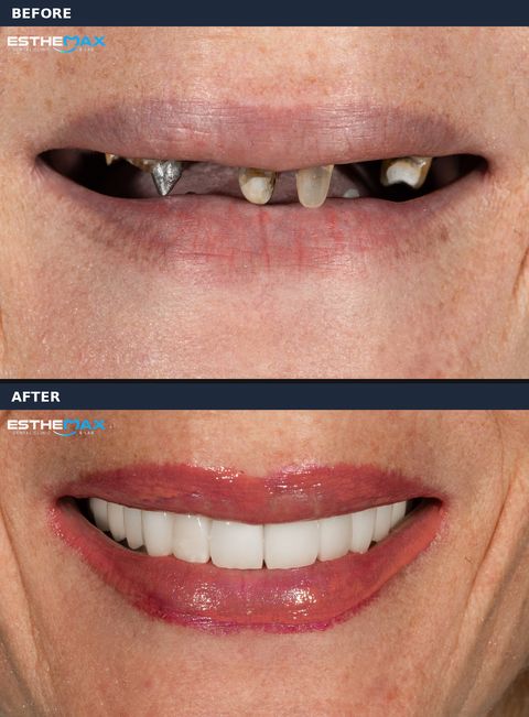 Before and after: a few worn, discoloured teeth and a metal post, replaced by a full row of even white teeth (view full size)