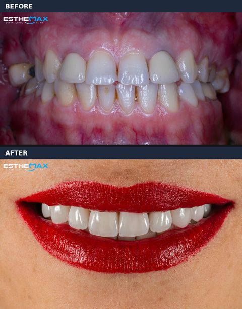Before and after veneers: uneven, discoloured teeth transformed into an even, bright smile (view full size)