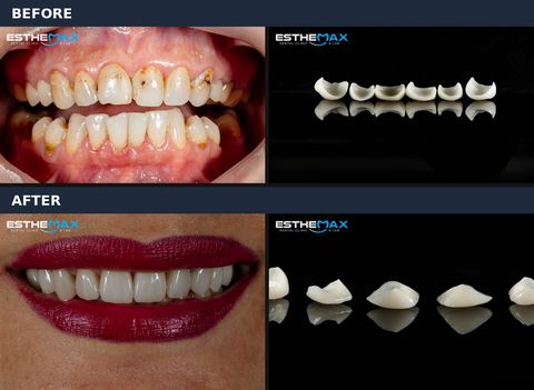 Before and after veneers: stained, worn teeth, the ceramic veneers themselves, and the finished smile (view full size)