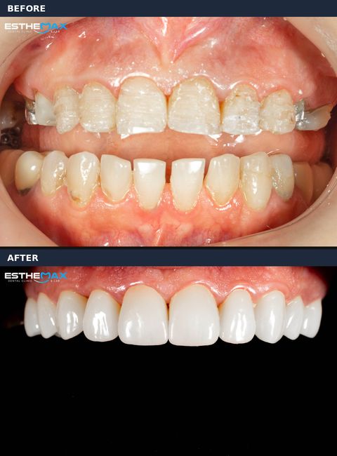 Before and after veneers: worn, uneven front teeth rebuilt into a full, even upper arch (view full size)