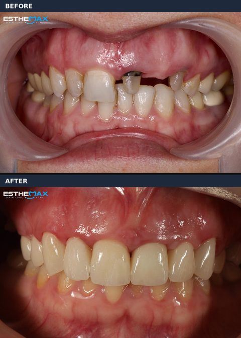 Before and after: a missing upper front tooth and a darkened, broken one, replaced by an even row of upper front teeth (view full size)