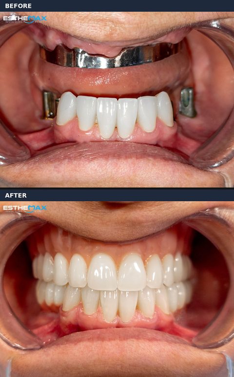 Before and after: a metal bar on the toothless upper gum and metal parts beside the lower front teeth, then full, even upper and lower teeth (view full size)
