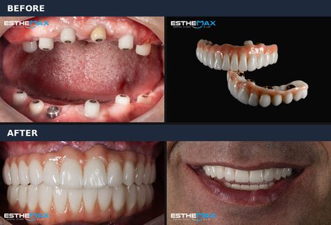 Before and after: implant abutments in both jaws and the two finished full-arch bridges, then the bridges in place and the smile (view full size)