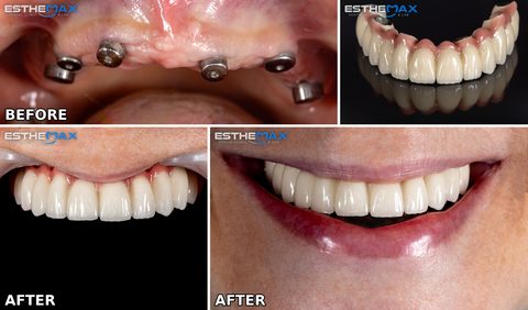 Before and after: implant abutments in the toothless upper jaw, then the new full row of upper teeth, on its own and in place, and the smile (view full size)