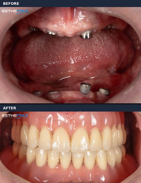 Before and after: implant abutments in the toothless upper and lower jaws, then full, even upper and lower teeth (view full size)