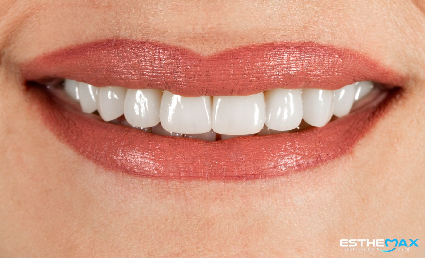 Porcelain veneer smile made at ESTHEMAX, Yerevan