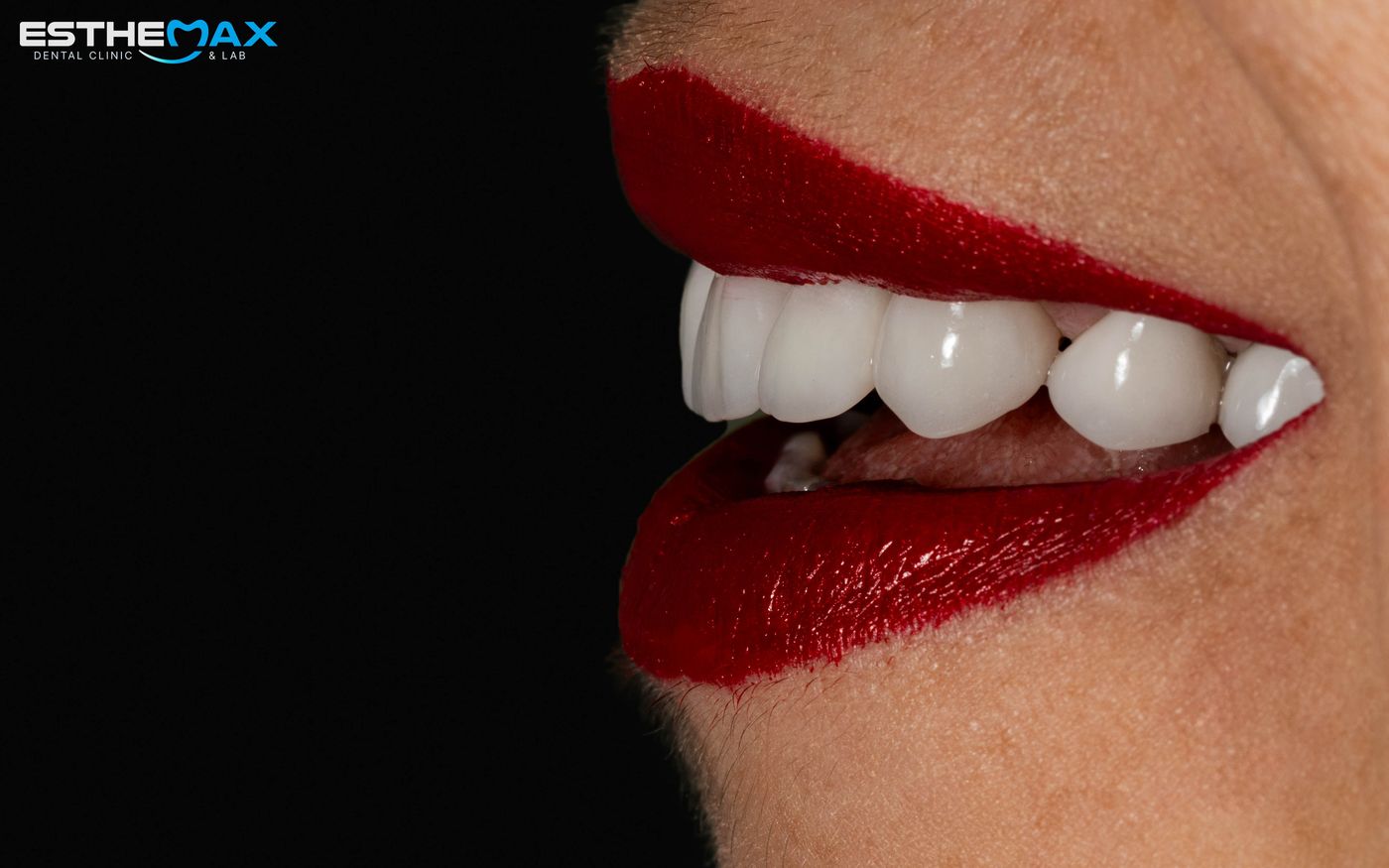 Finished smile at ESTHEMAX, side view: even, glossy upper teeth and red lipstick