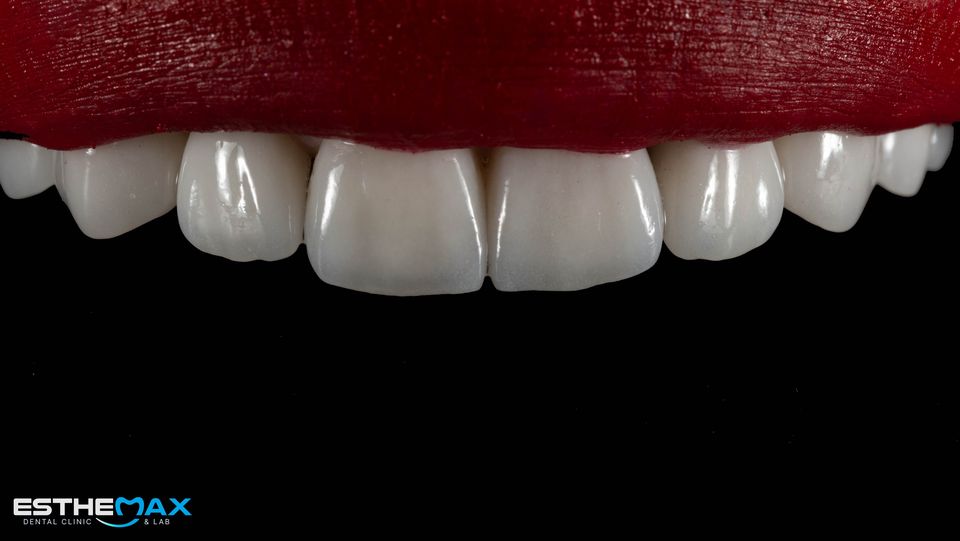 Close-up of finished porcelain veneers