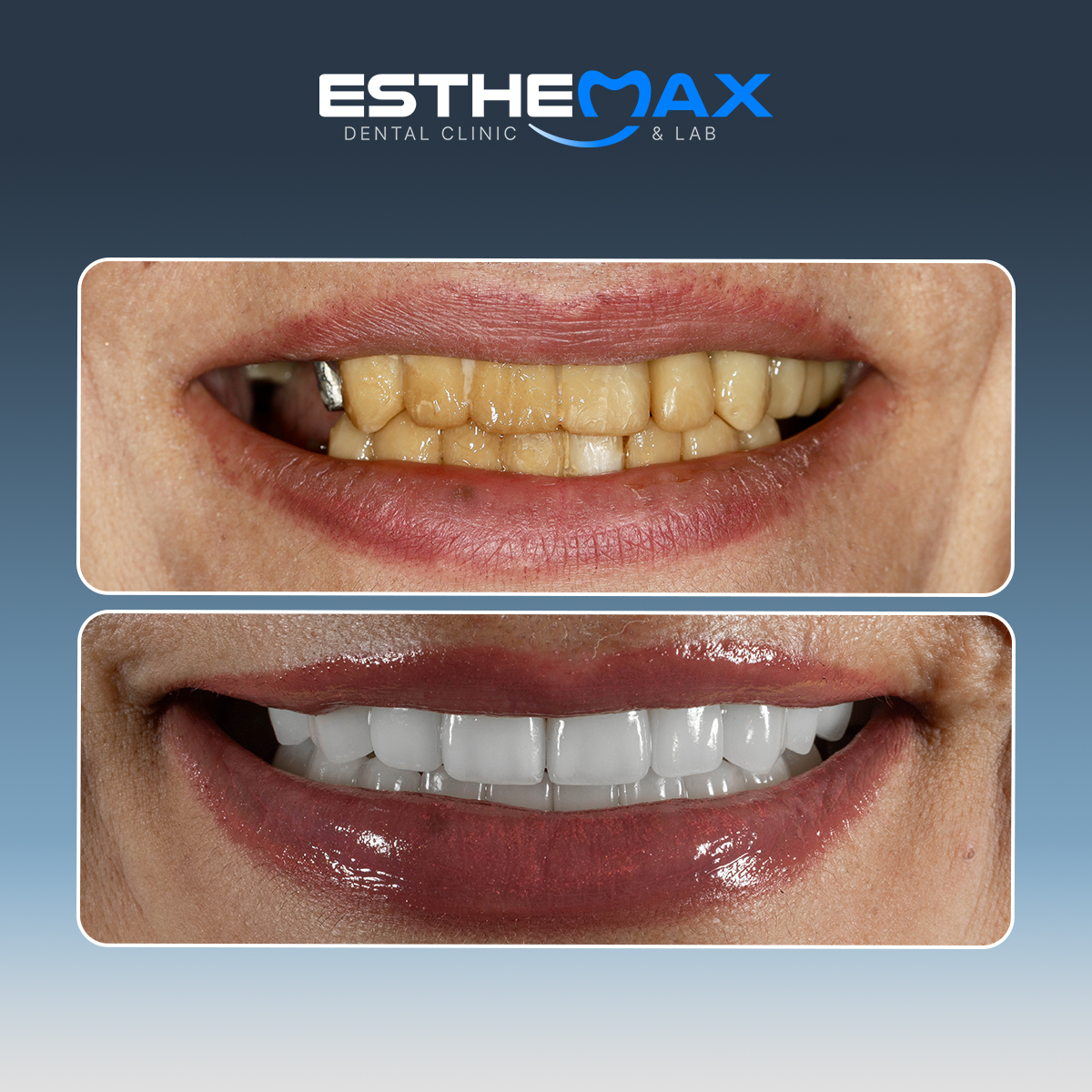 Complete smile makeover - before and after